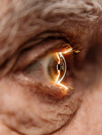 Glaucoma